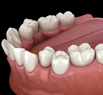 Illustration of crooked teeth