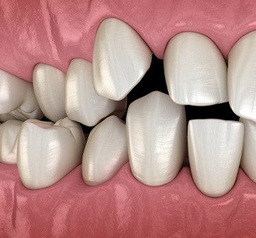 Illustration of spaced out teeth