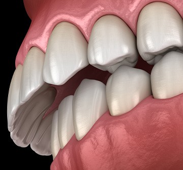 Illustration of overbite